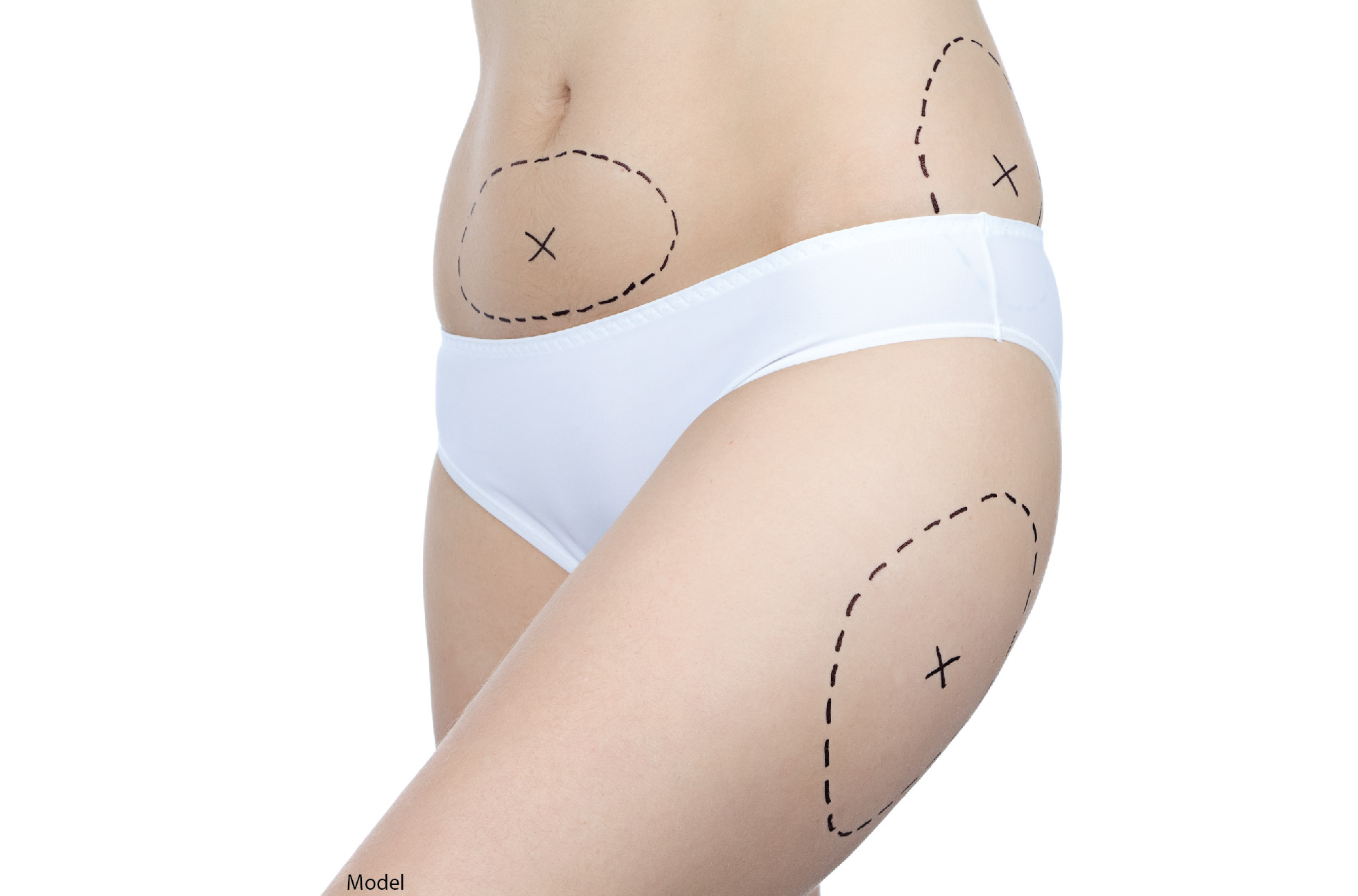 One Liposuction Session