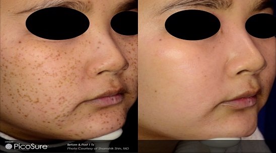 Brown Spots Removal