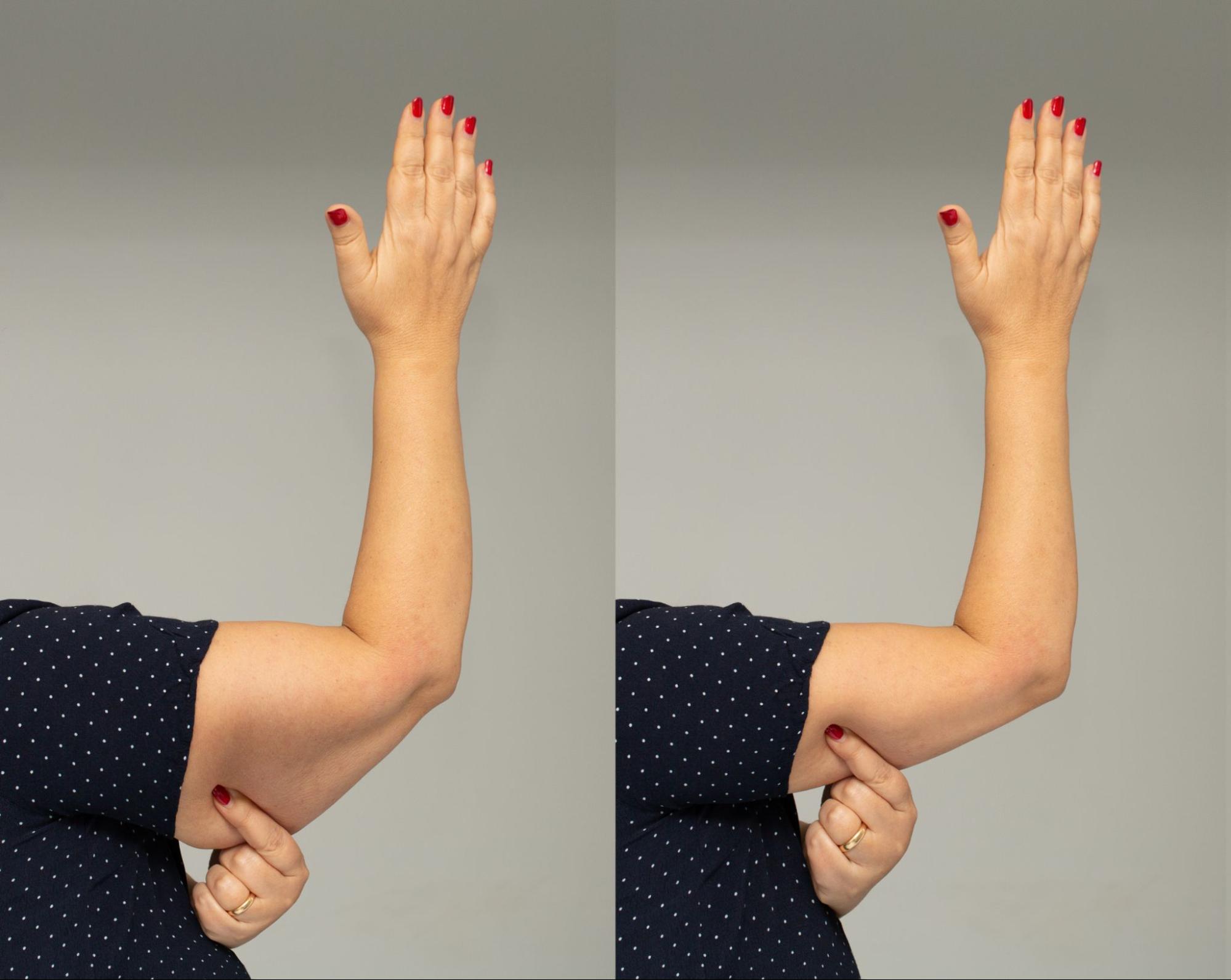 A before and after of sagging skin on the arm to represent plastic surgery after weight loss
