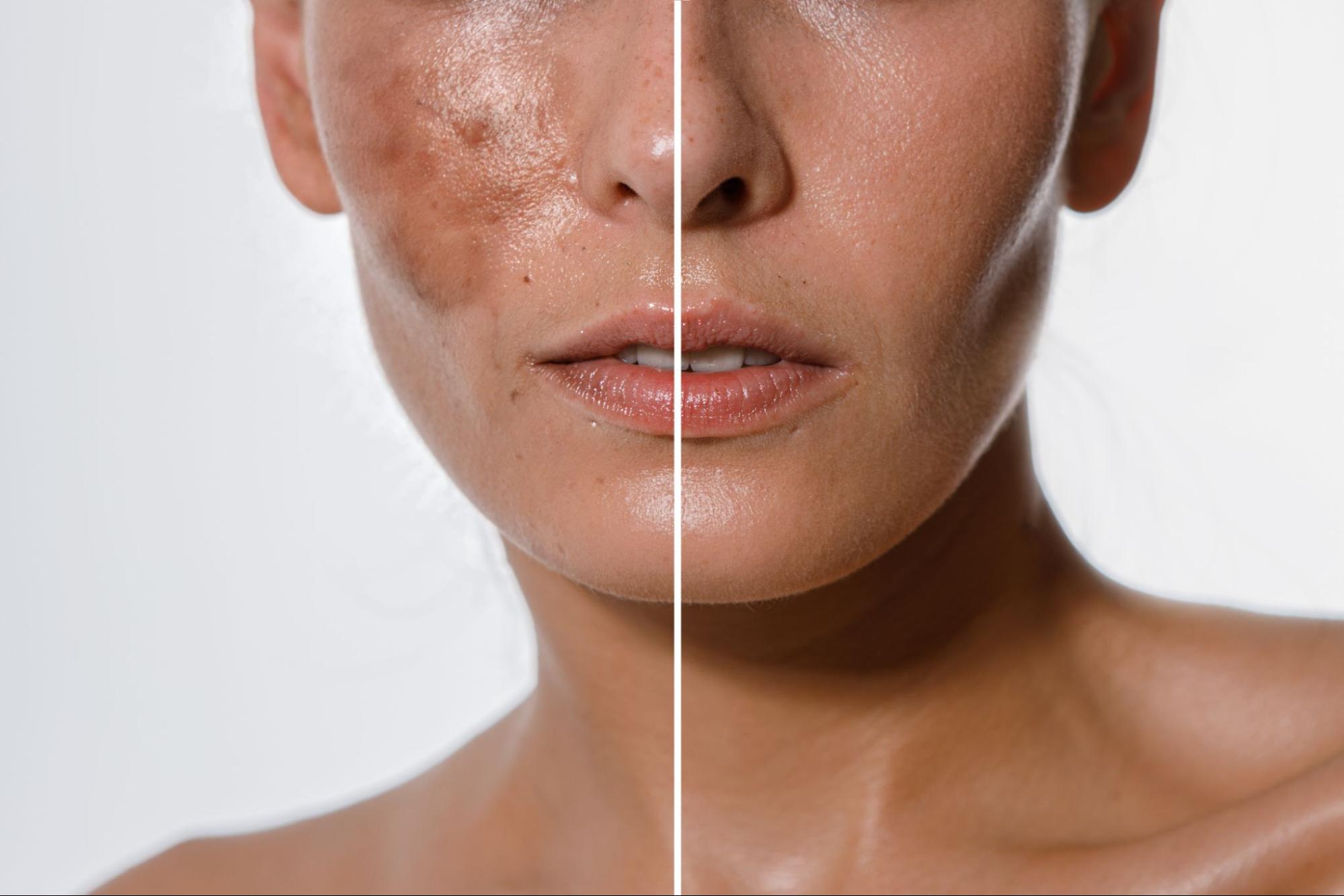 a before an after of pigmented skin to represent the effectiveness of pigmentation treatments