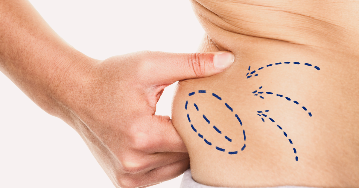 A skin bulge marked up to represent CoolSculpting Myths